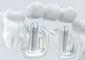 Model of dental implant bridge for missing multiple teeth in Rochester
